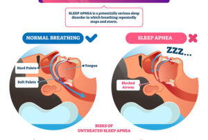 sleep Apnea